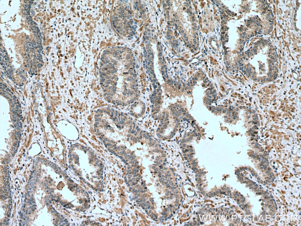 Immunohistochemistry (IHC) staining of human prostate cancer tissue using IL-24 Polyclonal antibody (12064-1-AP)