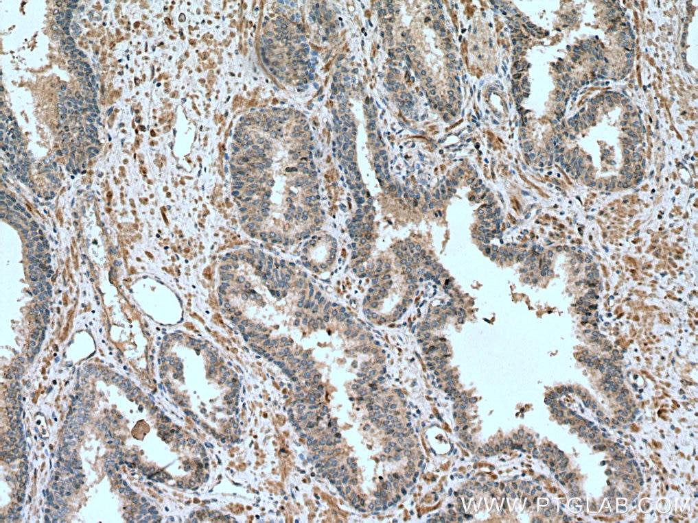 IHC staining of human prostate cancer using 12064-1-AP