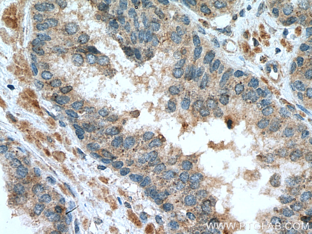 IHC staining of human prostate cancer using 12064-1-AP