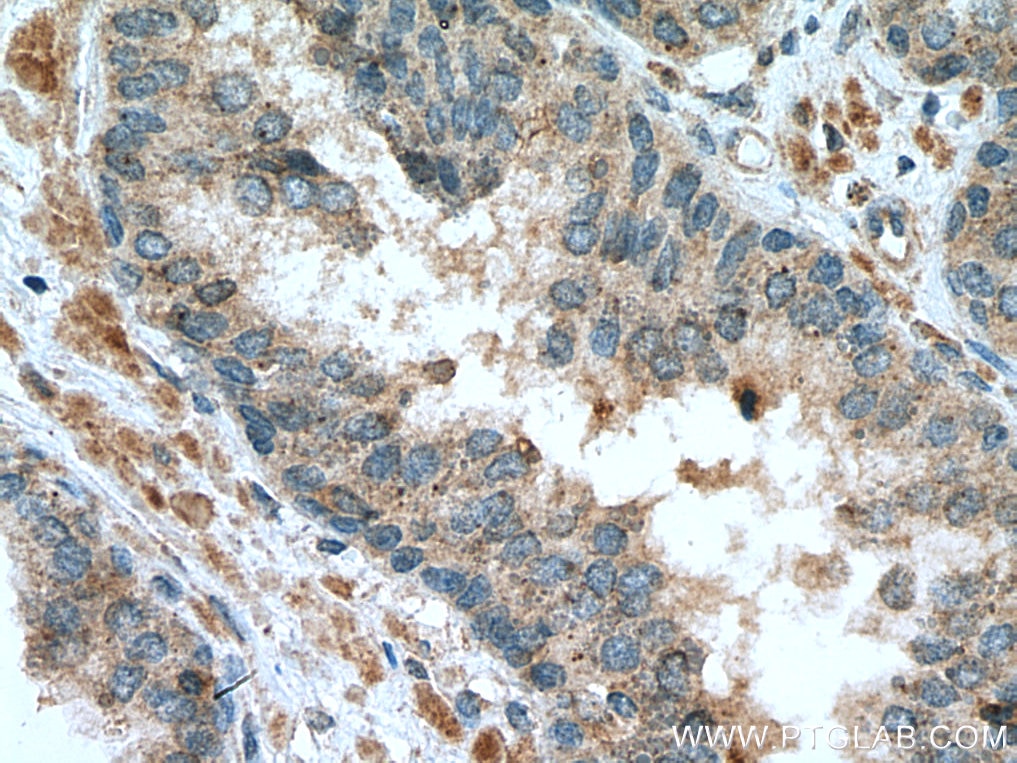 Immunohistochemistry (IHC) staining of human prostate cancer tissue using IL-24 Polyclonal antibody (12064-1-AP)