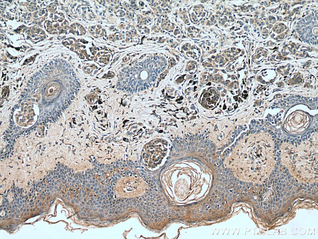 Immunohistochemistry (IHC) staining of human malignant melanoma tissue using IL-24 Polyclonal antibody (12064-1-AP)