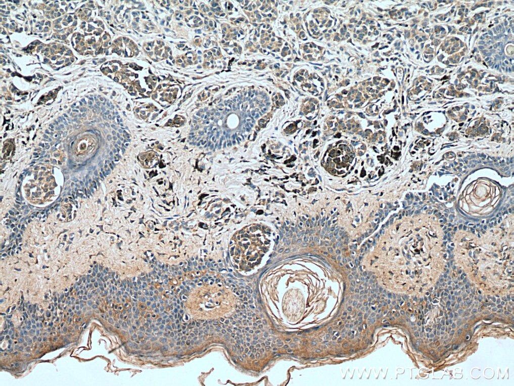 IHC staining of human malignant melanoma using 12064-1-AP