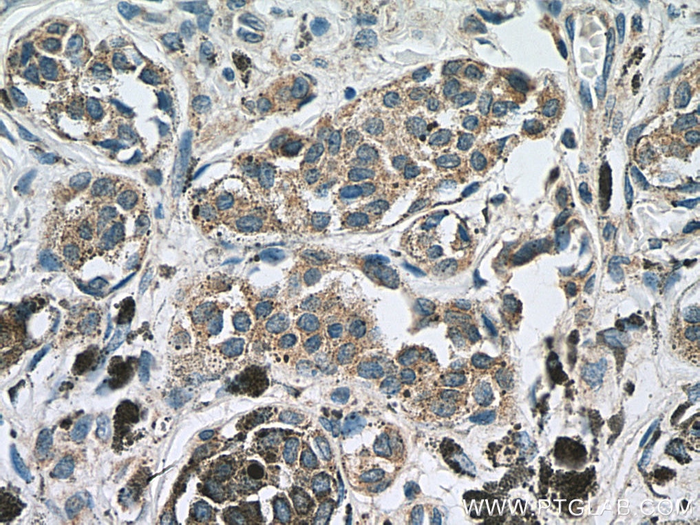 Immunohistochemistry (IHC) staining of human malignant melanoma tissue using IL-24 Polyclonal antibody (12064-1-AP)