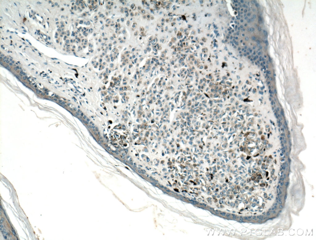 Immunohistochemistry (IHC) staining of human malignant melanoma tissue using IL-24 Polyclonal antibody (26772-1-AP)