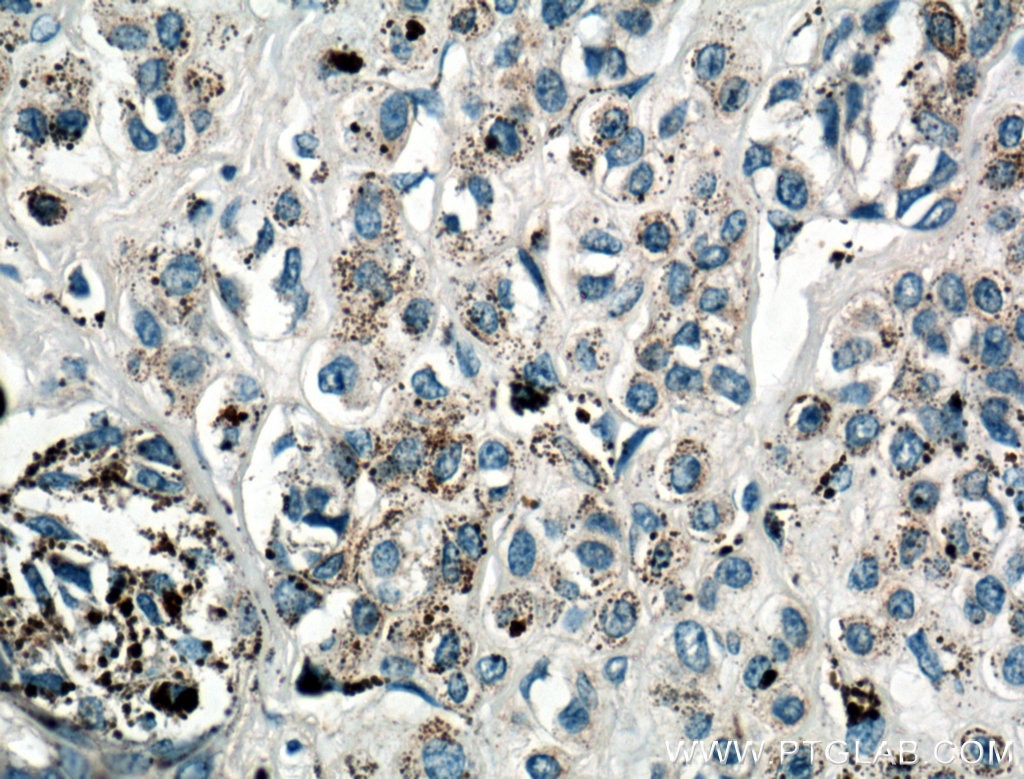 IHC staining of human malignant melanoma using 26772-1-AP