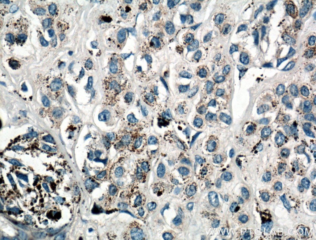 Immunohistochemistry (IHC) staining of human malignant melanoma tissue using IL-24 Polyclonal antibody (26772-1-AP)