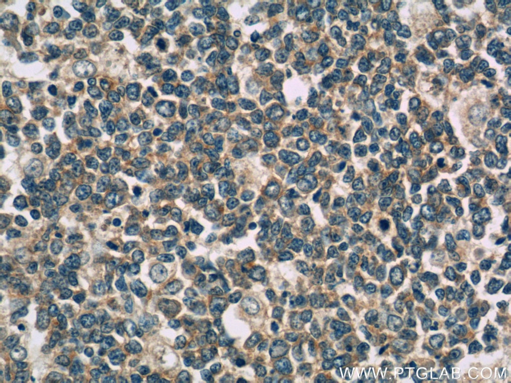 Immunohistochemistry (IHC) staining of human tonsillitis tissue using IL-28A Monoclonal antibody (60270-1-Ig)
