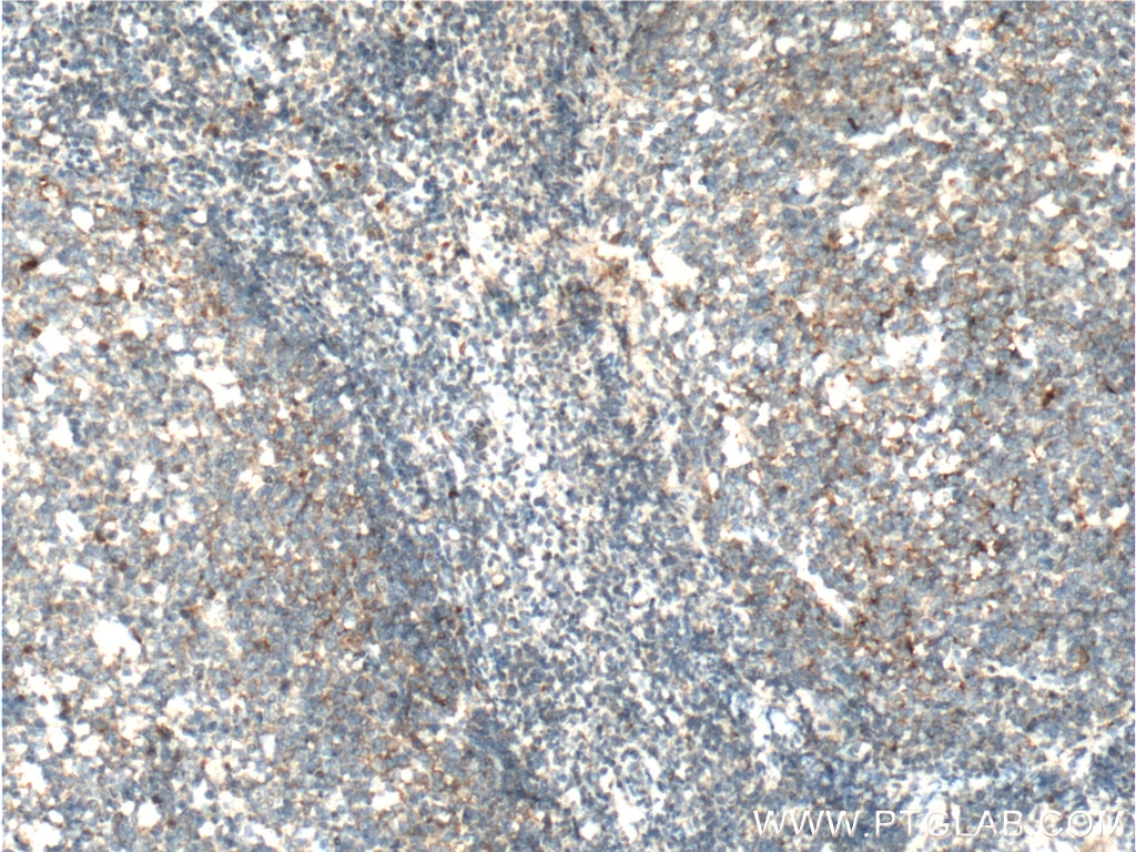 Immunohistochemistry (IHC) staining of human tonsillitis tissue using IL-3 Polyclonal antibody (17835-1-AP)