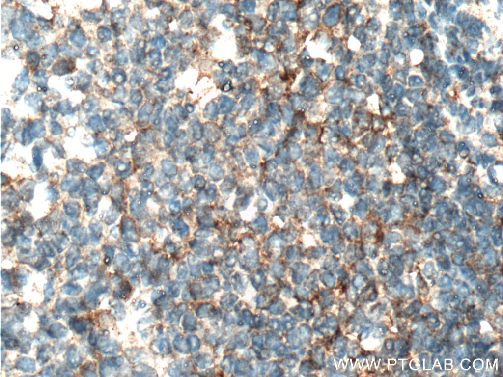 Immunohistochemistry (IHC) staining of human tonsillitis tissue using IL-3 Polyclonal antibody (17835-1-AP)
