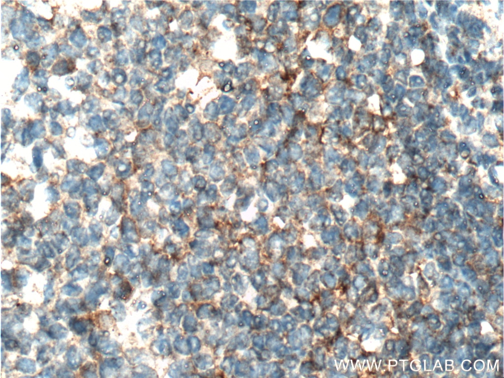 IHC staining of human tonsillitis using 17835-1-AP