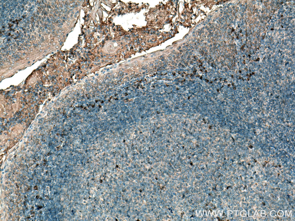 Immunohistochemistry (IHC) staining of human tonsillitis tissue using IL-31 Polyclonal antibody (22859-1-AP)