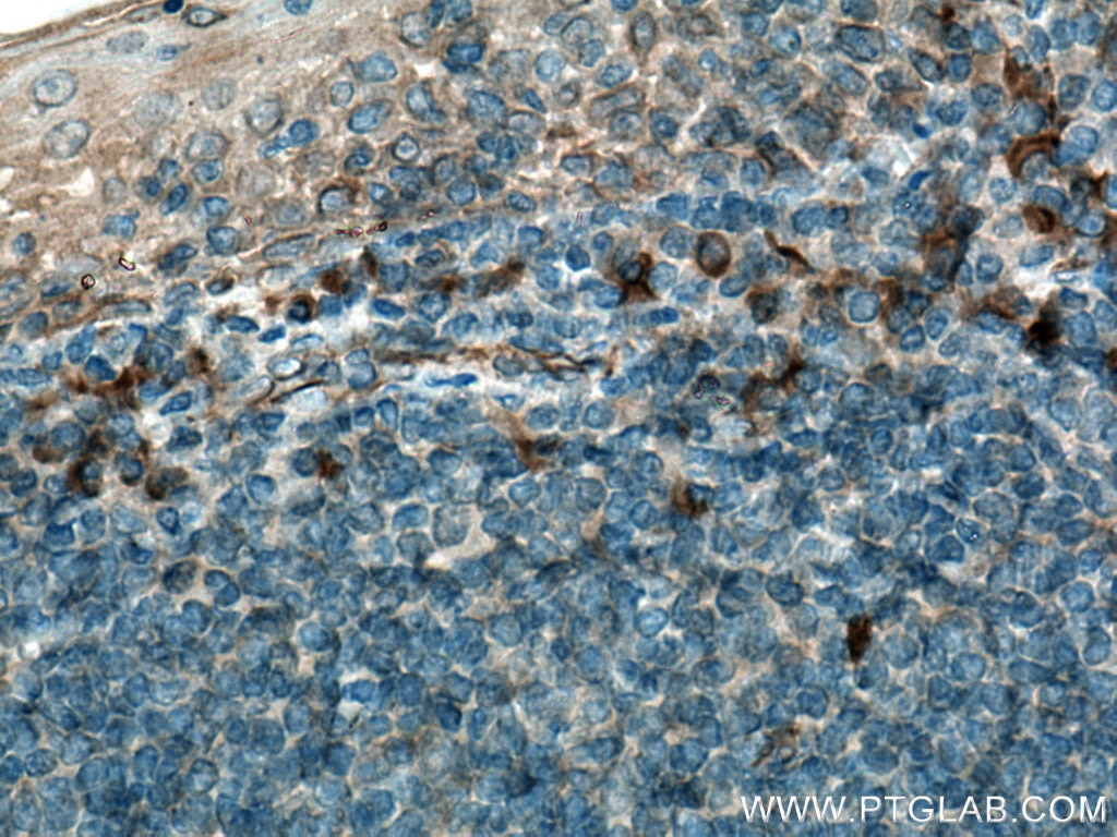 Immunohistochemistry (IHC) staining of human tonsillitis tissue using IL-31 Polyclonal antibody (22859-1-AP)