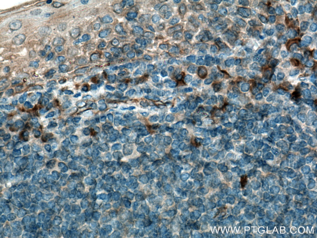 IHC staining of human tonsillitis using 22859-1-AP