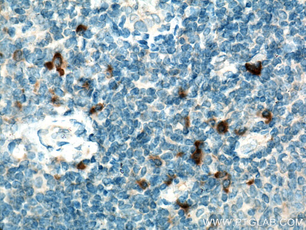 Immunohistochemistry (IHC) staining of human tonsillitis tissue using IL-31 Polyclonal antibody (22859-1-AP)