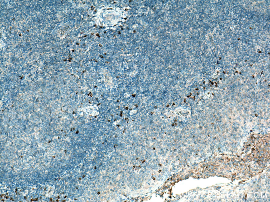 IHC staining of human tonsillitis using 22859-1-AP