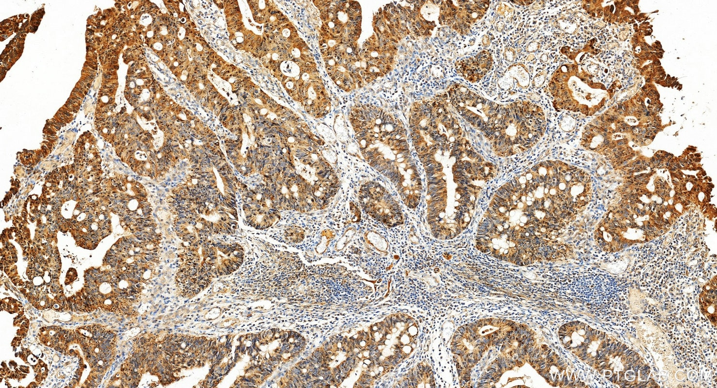 Immunohistochemistry (IHC) staining of human colon cancer tissue using IL-32 Polyclonal antibody (11079-1-AP)