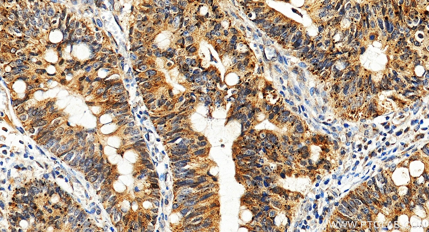 Immunohistochemistry (IHC) staining of human colon cancer tissue using IL-32 Polyclonal antibody (11079-1-AP)