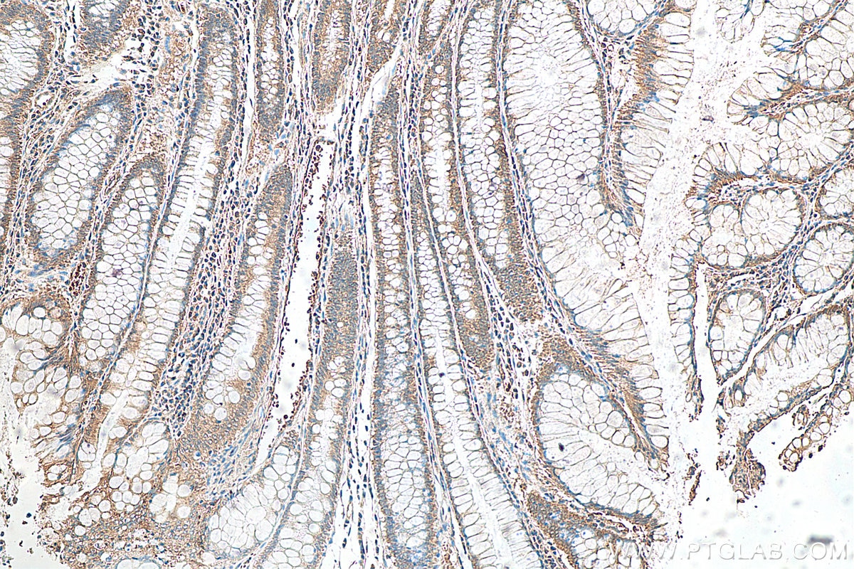 IHC staining of human colon cancer using 11079-1-AP