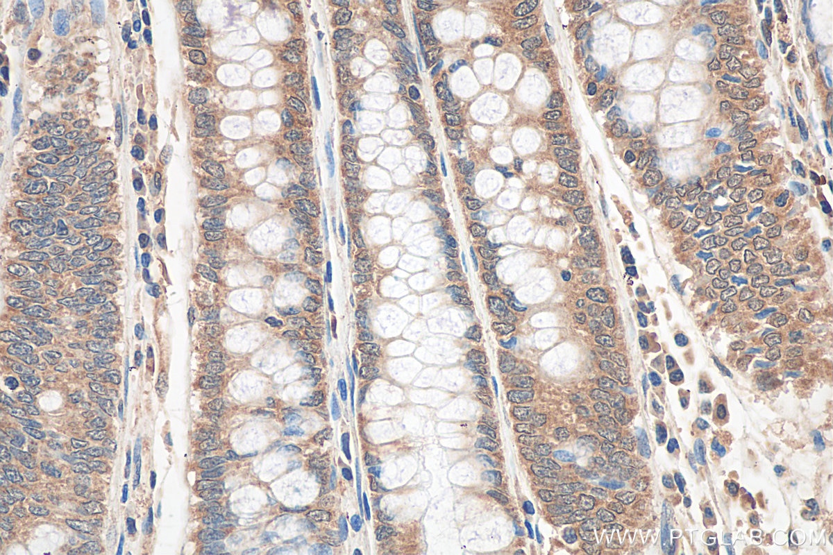 Immunohistochemistry (IHC) staining of human colon cancer tissue using IL-32 Polyclonal antibody (11079-1-AP)