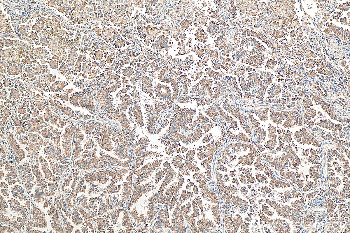 Immunohistochemistry (IHC) staining of human lung cancer tissue using IL-32 Polyclonal antibody (11079-1-AP)