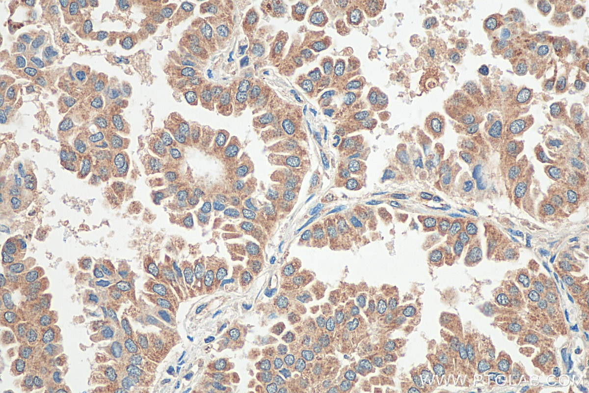 Immunohistochemistry (IHC) staining of human lung cancer tissue using IL-32 Polyclonal antibody (11079-1-AP)