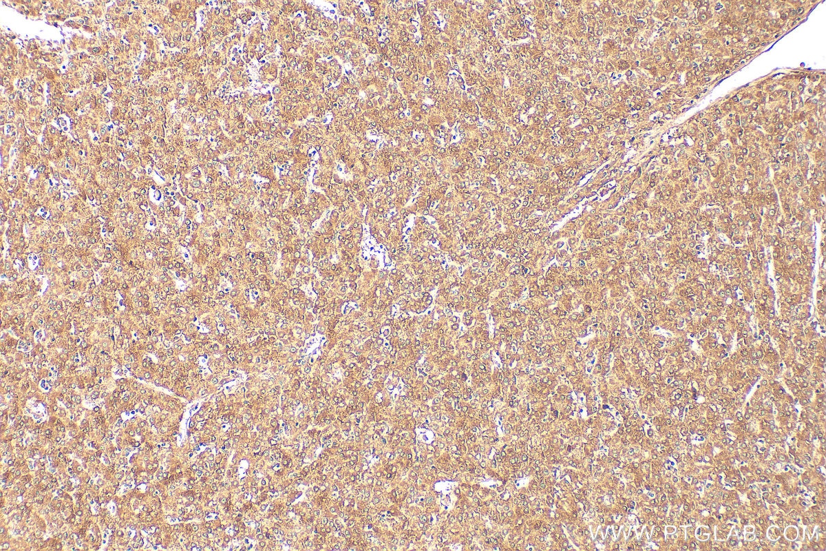 IHC staining of human liver cancer using 12372-1-AP Immunohistochemistry (IHC) staining of human liver cancer tissue using IL-33 Polyclonal antibody (12372-1-AP)