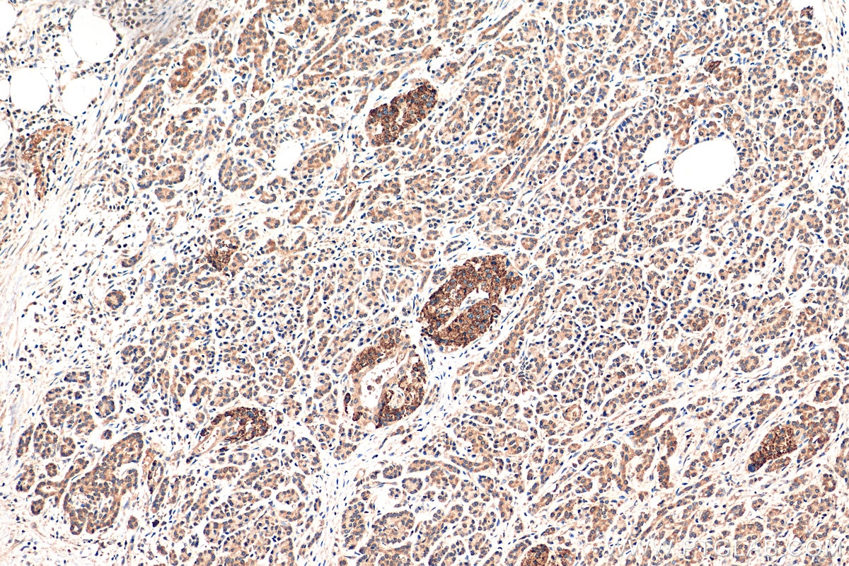 Immunohistochemistry (IHC) staining of human pancreas cancer tissue using IL-33 Monoclonal antibody (66235-1-Ig)