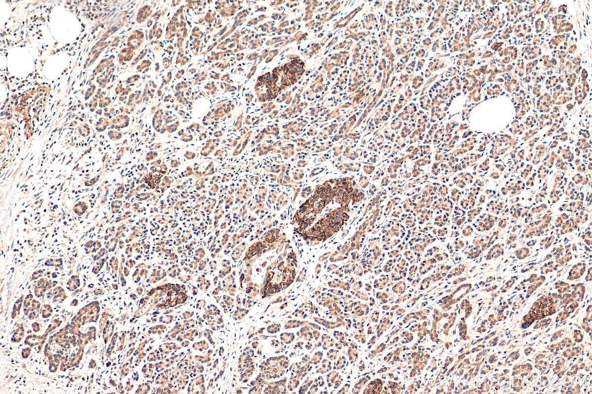 IHC staining of human pancreas cancer using 66235-1-Ig