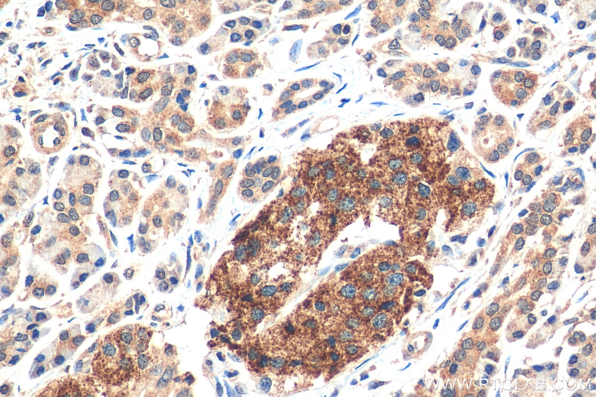 Immunohistochemistry (IHC) staining of human pancreas cancer tissue using IL-33 Monoclonal antibody (66235-1-Ig)