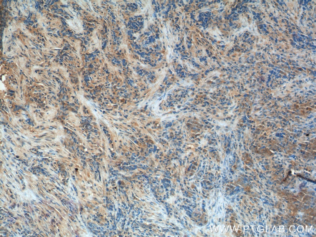 IHC staining of human nasopharyngeal carcinoma using 66235-1-Ig