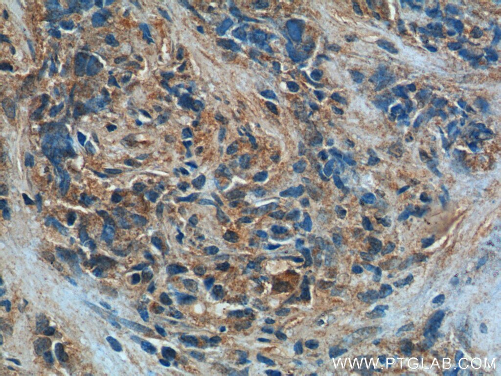 IHC staining of human nasopharyngeal carcinoma using 66235-1-Ig