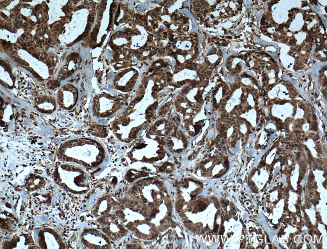Immunohistochemistry (IHC) staining of human breast cancer tissue using IL-1F7/IL-37 Monoclonal antibody (60296-1-Ig)