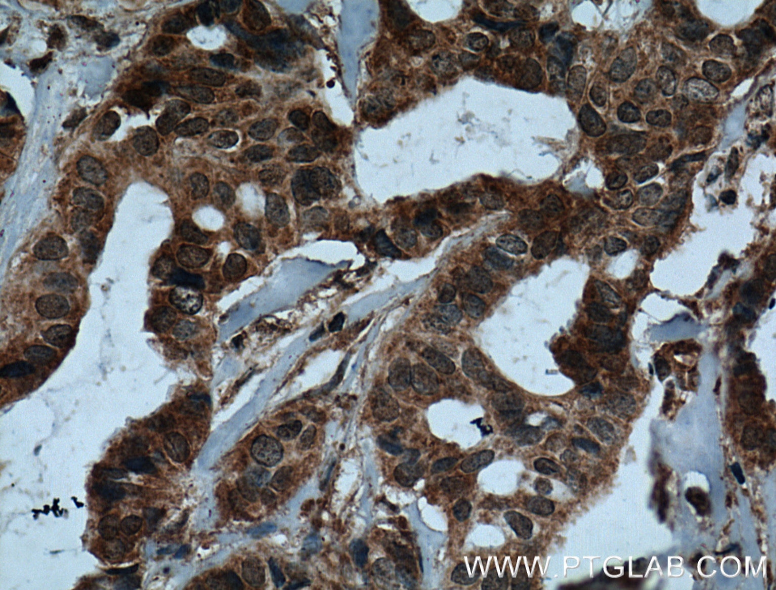 IHC staining of human breast cancer using 60296-1-Ig