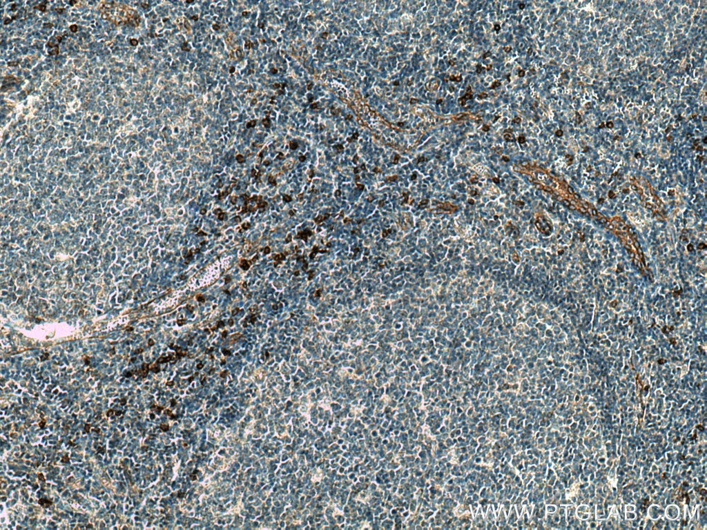 Immunohistochemistry (IHC) staining of human tonsillitis tissue using IL-3RA Polyclonal antibody (13655-1-AP)