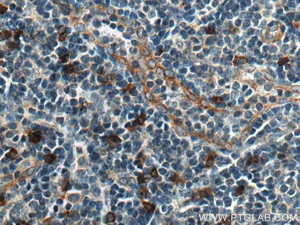 Immunohistochemistry (IHC) staining of human tonsillitis tissue using IL-3RA Polyclonal antibody (13655-1-AP)