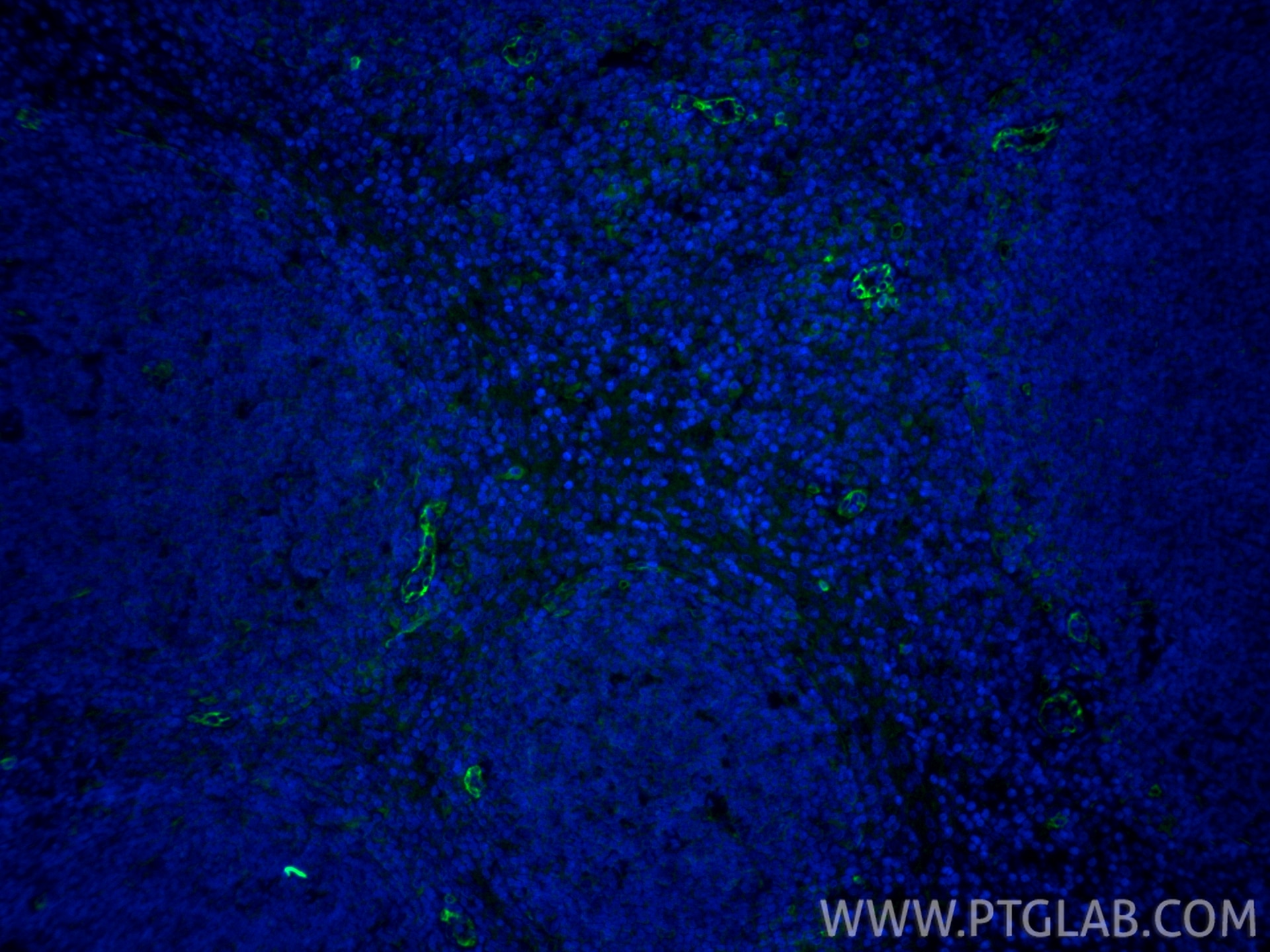 IF Staining of human tonsillitis using 84256-1-RR Immunofluorescence (IF) / fluorescent staining of human tonsillitis tissue using IL3RA/CD123 Recombinant monoclonal antibody (84256-1-RR)