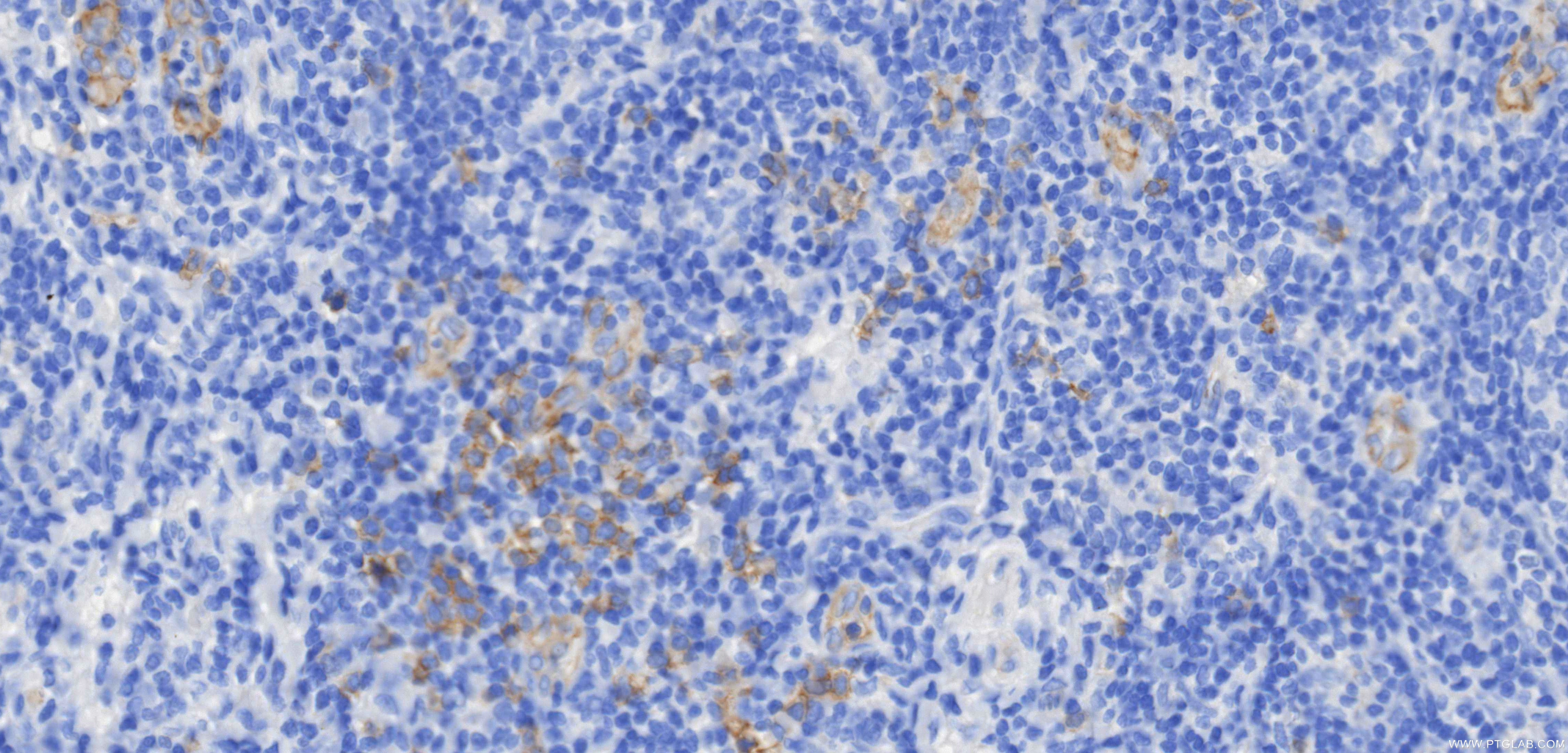 Immunohistochemical analysis of paraffin-embedded human tonsil tissue slide using 84256-1-RR (IL3RA/CD123 antibody) at dilution of 1:500 (under 40x lens). Heat mediated antigen retrieval with Tris-EDTA buffer (pH 9.0). This data was developed using the same antibody clone with 84256-1-PBS in a different storage buffer formulation. Immunohistochemistry (IHC) staining of human tonsil tissue using IL3RA/CD123 Recombinant monoclonal antibody (84256-1-RR)