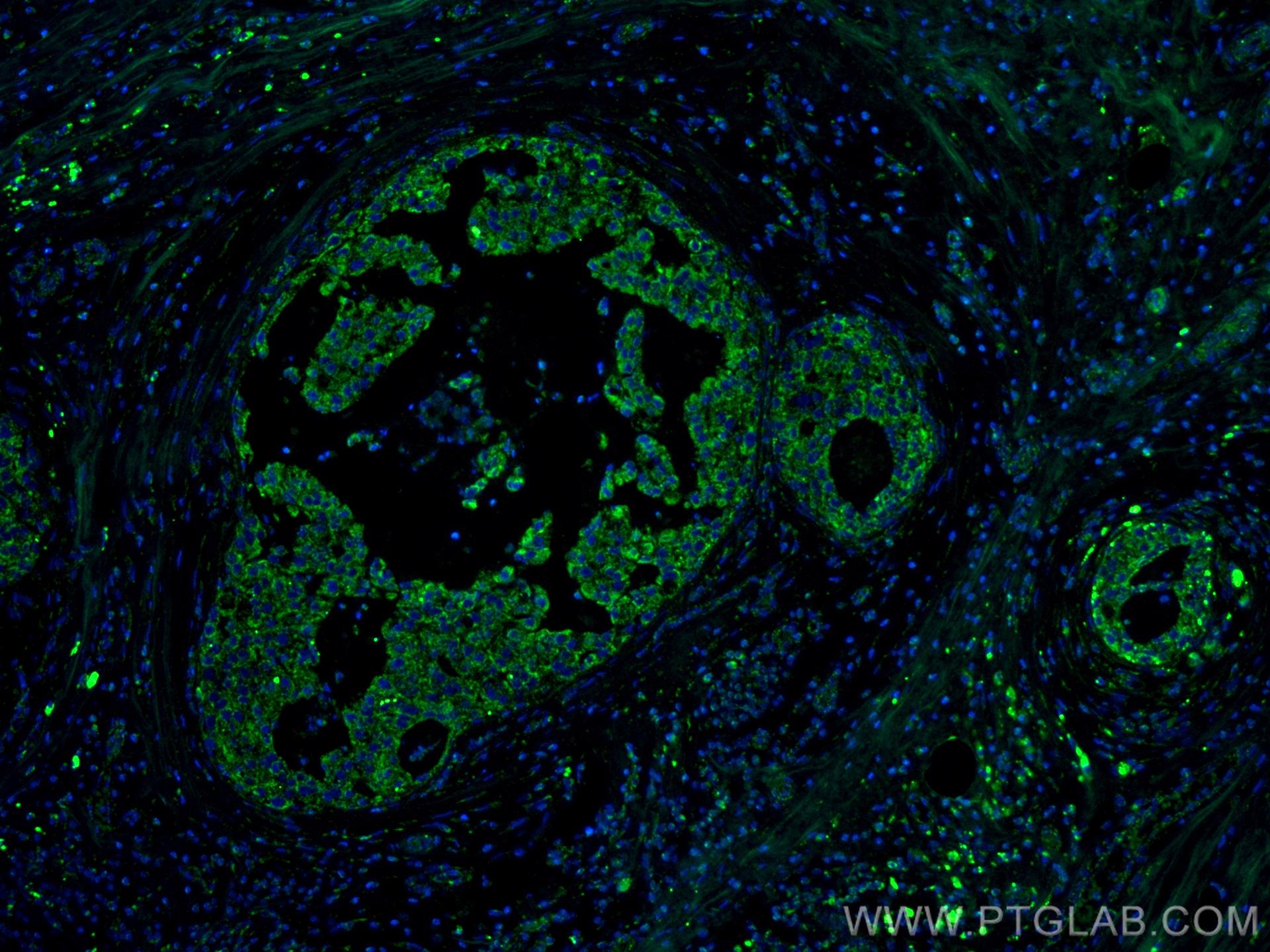Immunofluorescence (IF) / fluorescent staining of human breast cancer tissue using IL-4 Monoclonal antibody (66142-1-Ig)