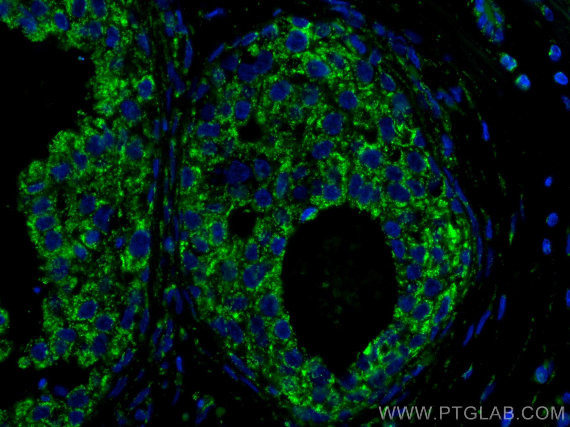 Immunofluorescence (IF) / fluorescent staining of human breast cancer tissue using IL-4 Monoclonal antibody (66142-1-Ig)