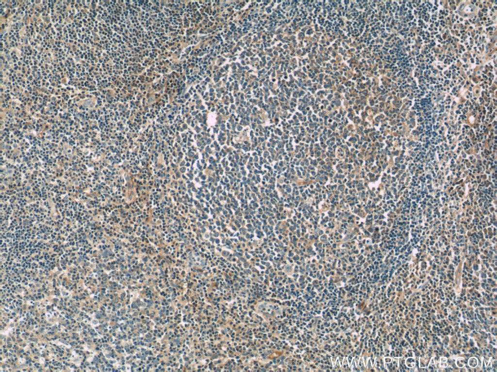 Immunohistochemistry (IHC) staining of human tonsillitis tissue using IL-4 Monoclonal antibody (66142-1-Ig)