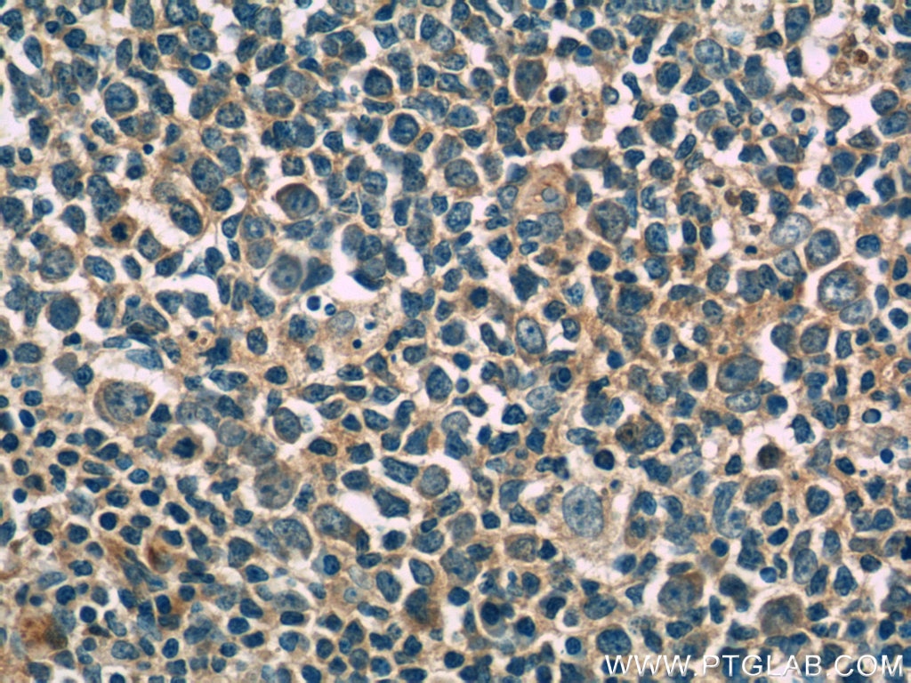 Immunohistochemistry (IHC) staining of human tonsillitis tissue using IL-4 Monoclonal antibody (66142-1-Ig)