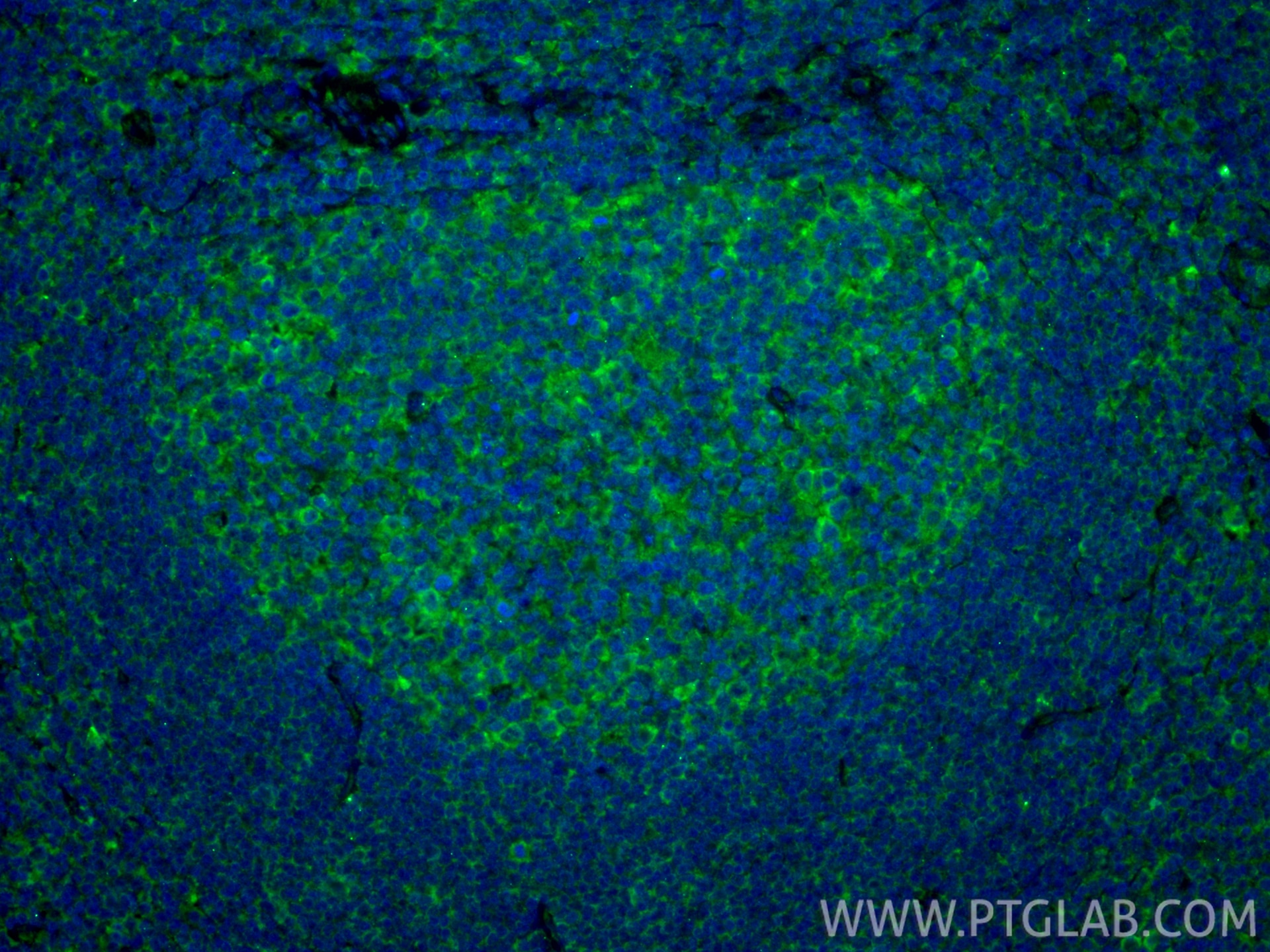 IF Staining of human tonsillitis using 28331-1-AP Immunofluorescence (IF) / fluorescent staining of human tonsillitis tissue using IL-4RA/CD124 Polyclonal antibody (28331-1-AP)