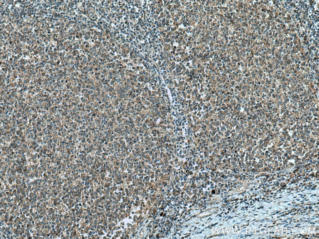 Immunohistochemistry (IHC) staining of human tonsillitis tissue using IL-4R Polyclonal antibody (28331-1-AP)