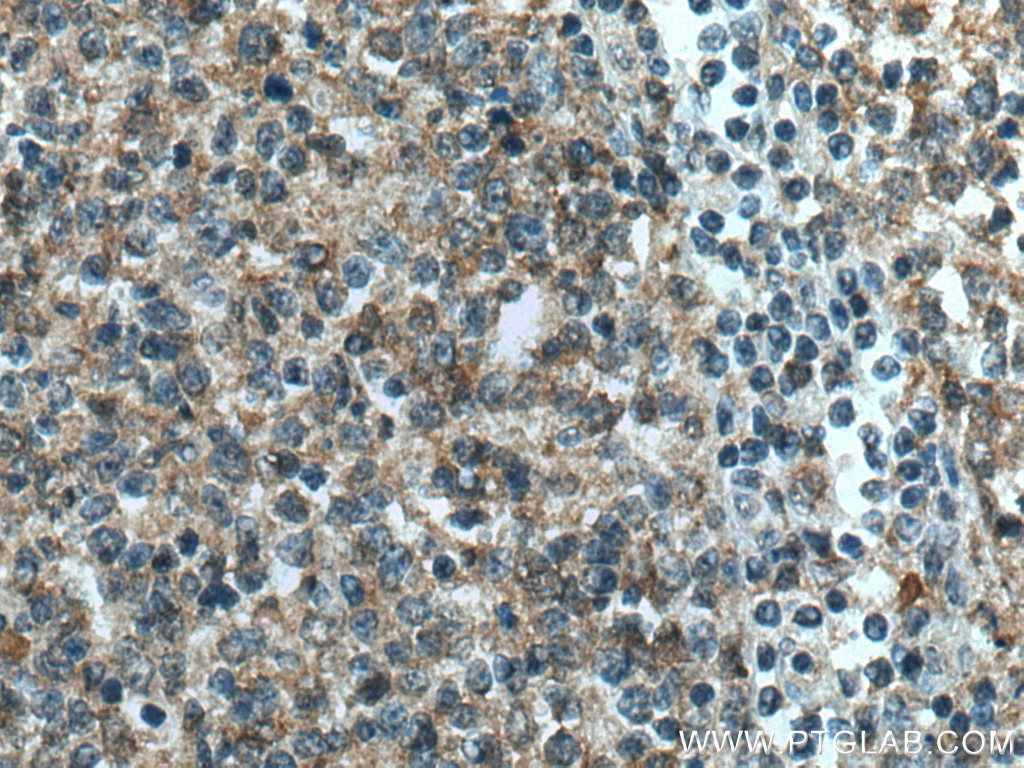 Immunohistochemistry (IHC) staining of human tonsillitis tissue using IL-4R Polyclonal antibody (28331-1-AP)