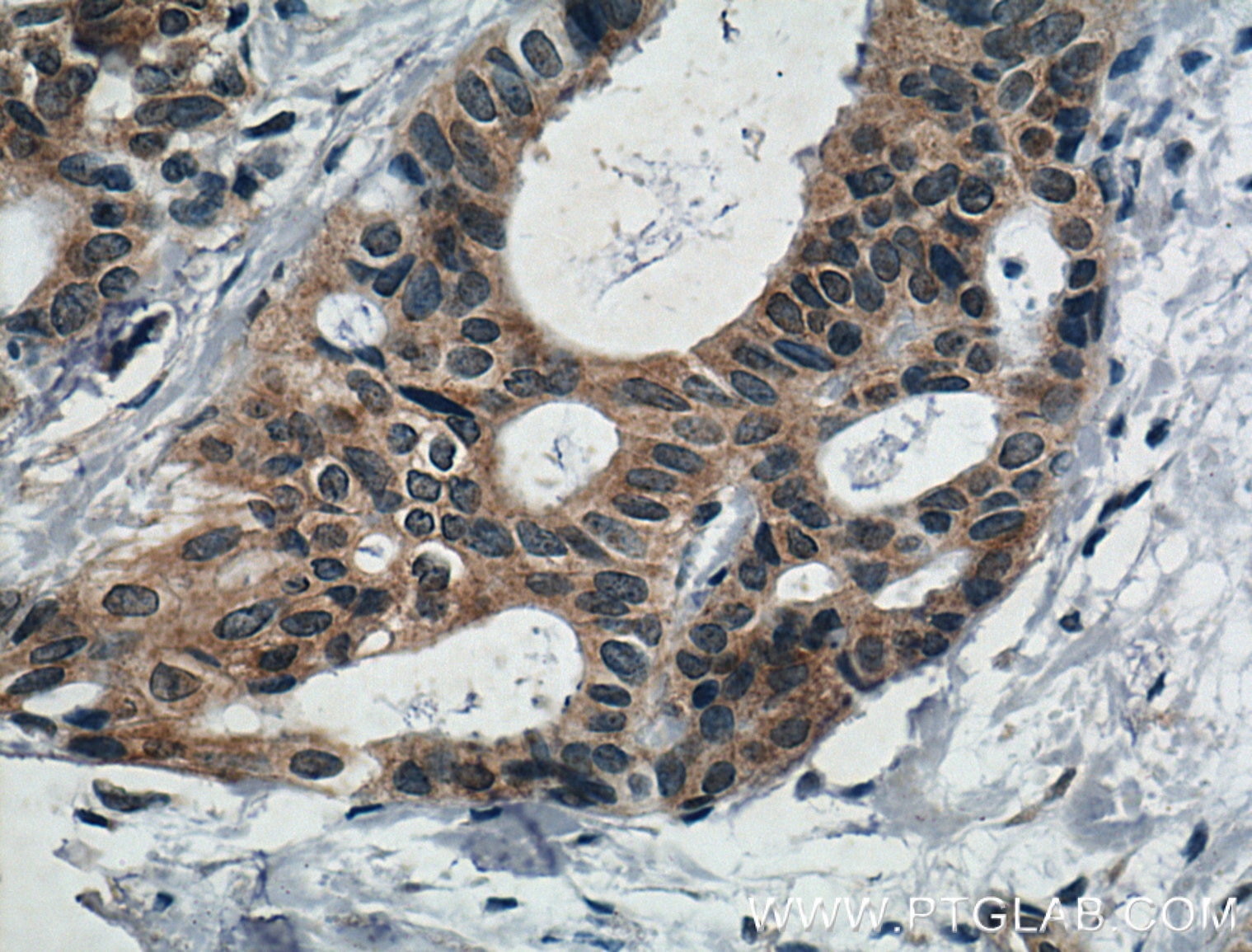 Immunohistochemistry (IHC) staining of human breast cancer tissue using IL-5 Polyclonal antibody (26677-1-AP)
