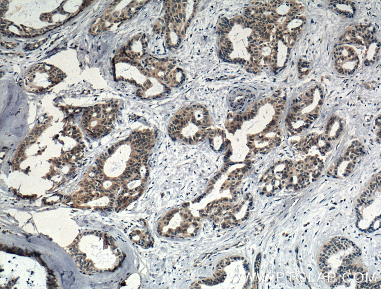 Immunohistochemistry (IHC) staining of human breast cancer tissue using IL-5 Polyclonal antibody (26677-1-AP)