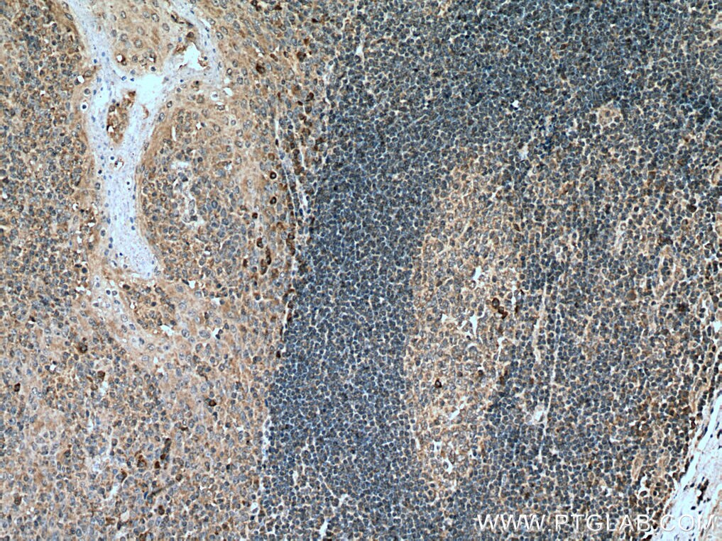Immunohistochemistry (IHC) staining of human tonsillitis tissue using IL-6R alpha Polyclonal antibody (23457-1-AP)