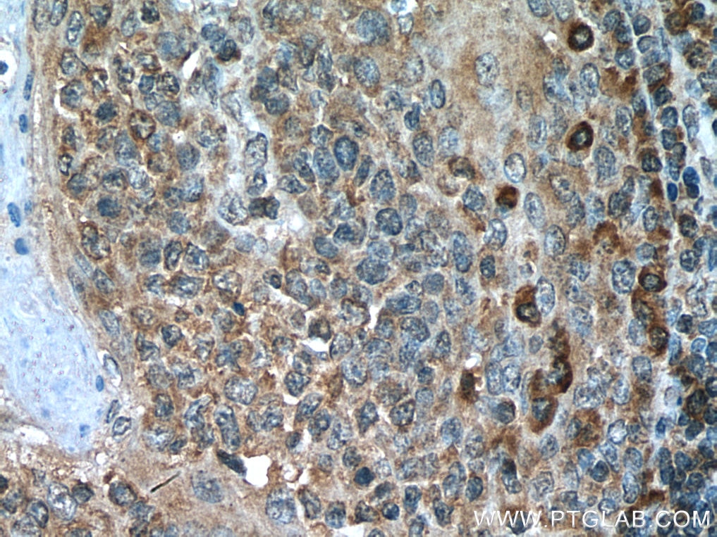 Immunohistochemistry (IHC) staining of human tonsillitis tissue using IL-6R alpha Polyclonal antibody (23457-1-AP)