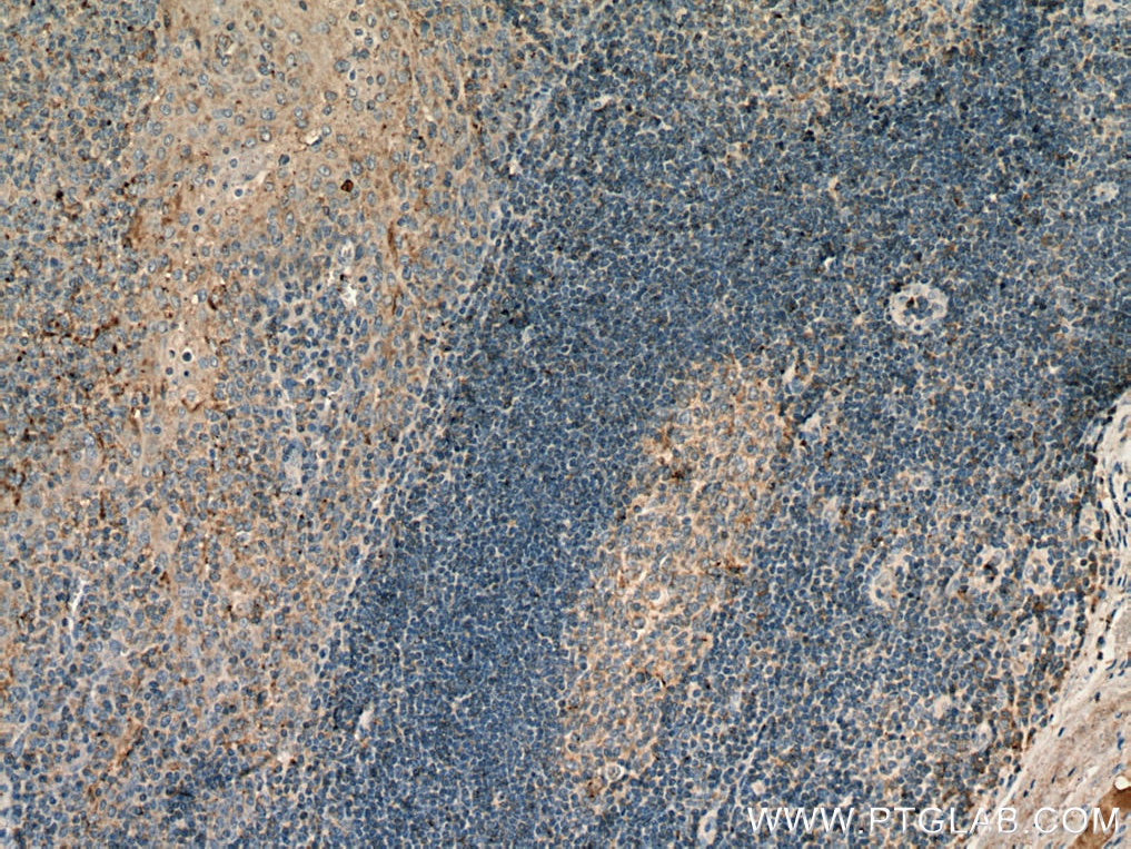 Immunohistochemistry (IHC) staining of human tonsillitis tissue using CD126/IL-6R alpha Monoclonal antibody (66855-1-Ig)