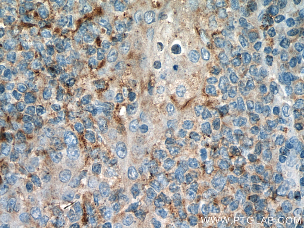 Immunohistochemistry (IHC) staining of human tonsillitis tissue using IL-6R alpha Monoclonal antibody (66855-1-Ig)